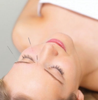 Woman Undergoing Facial Acupuncture Image